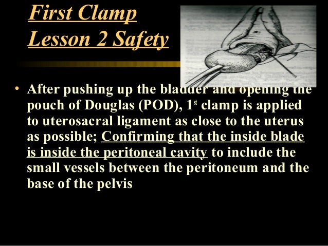 vaginal hysterectomy ppt Vaginal hysterectomy ppt
